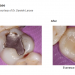 Class I Restoration Case Dentistry and photography courtesy of Dr. Daniele Larose